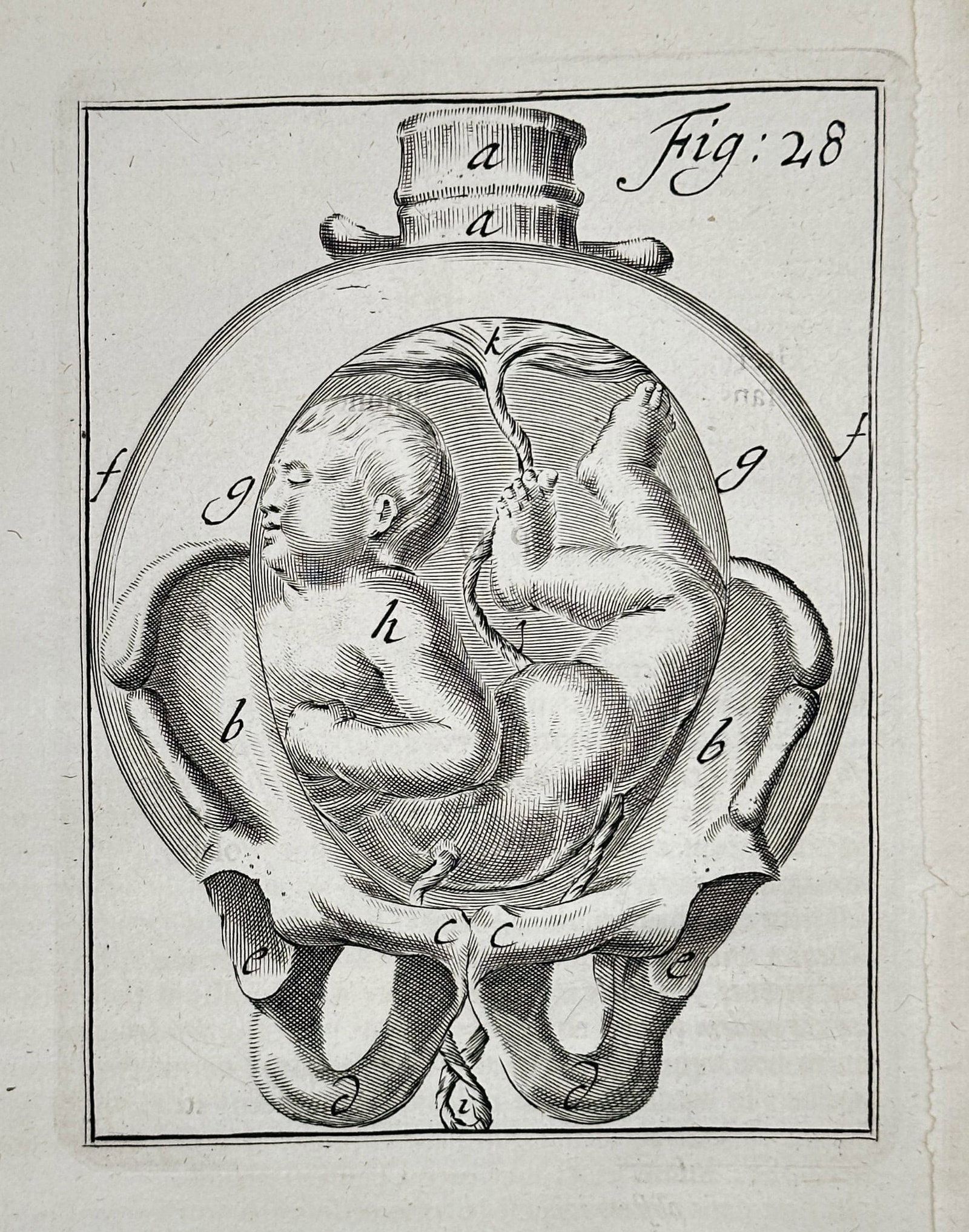 Hendrik van Deventer (1657–1724) - Breech Fetus Presentation - Copperplate: This copperplate engraving is a medical illustration depicting a fetus positioned within a woman's pelvis. The anatomical view shows the fetus in a breech or transverse presentation, illustrating a ch