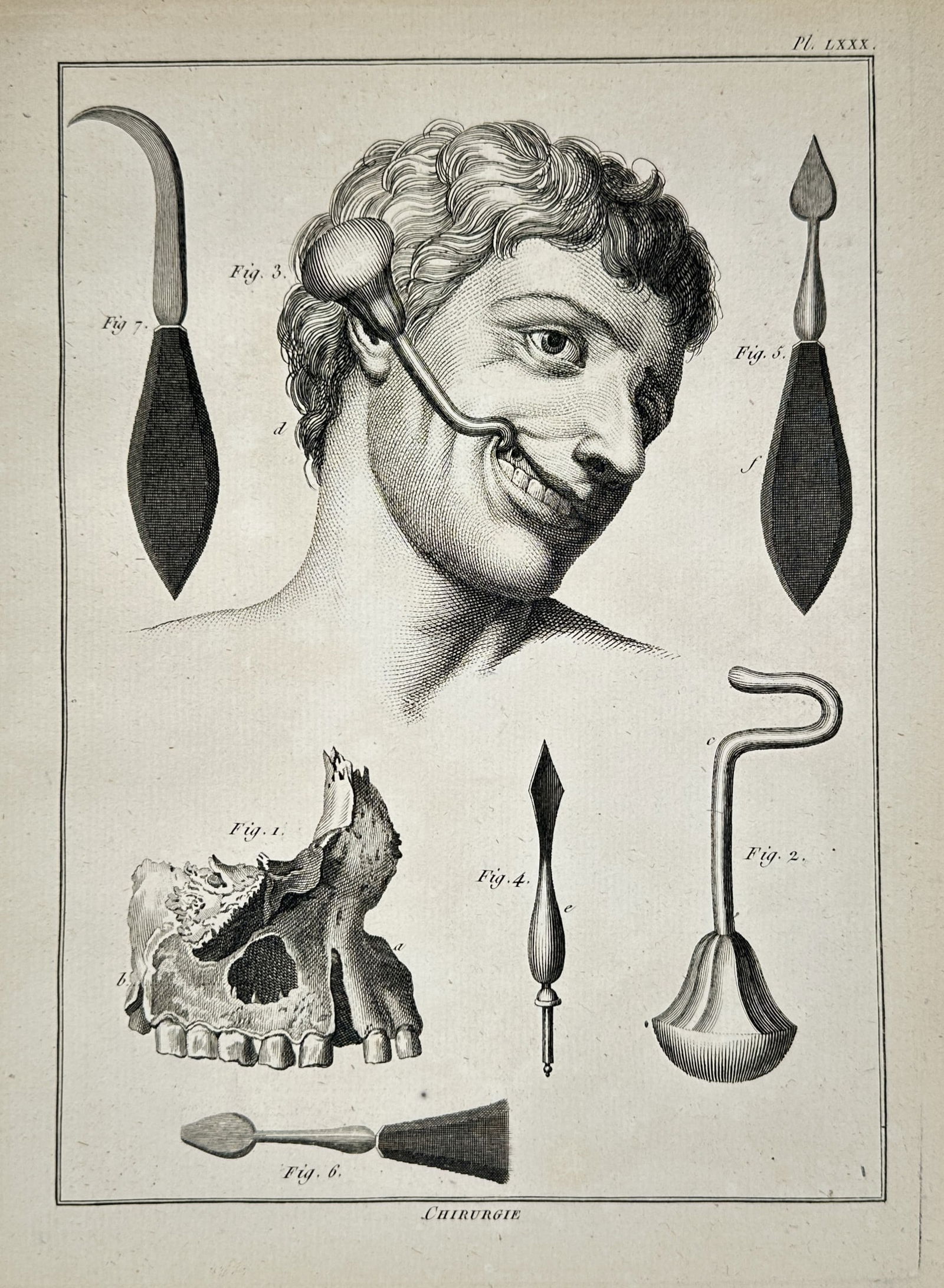 Robert Bénard (1734–c. 1785) – Surgical Tools for Facial and Dental Procedures – Engraving: "Chirurgie" presents a specialized technical study of medical instruments used for surgeries of the face, jaw, and mouth during the eighteenth century. The central figure illustrates the application o