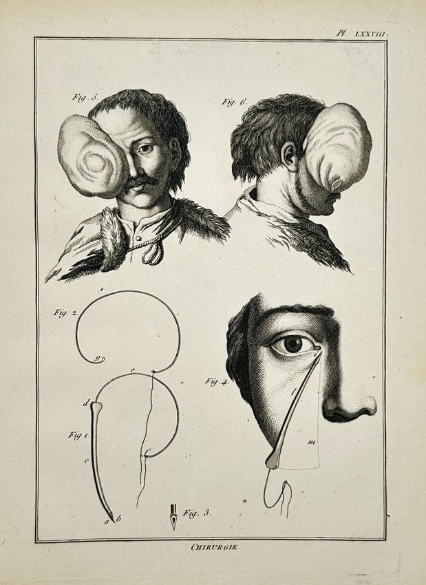 Robert Bénard (1734–1777) – Technical Illustration of Ophthalmic Surgery and Bandaging: "Chirurgie." This engraving illustrates specialized surgical procedures and dressings related to ophthalmic medicine in the eighteenth century. The upper register features two portraits of a male pati
