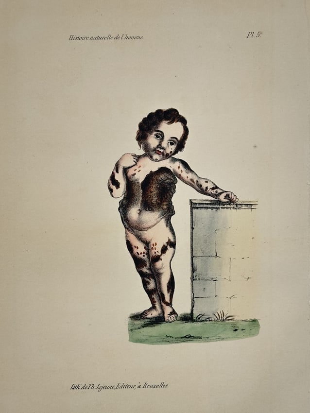 Georges-Louis Leclerc, Comte de Buffon – Child with Hypertrichosis – Lithograph: This lithograph features a classical representation of a young child with hypertrichosis, depicted in a standing pose against a stone architectural plinth and a small patch of grass. The work was publ
