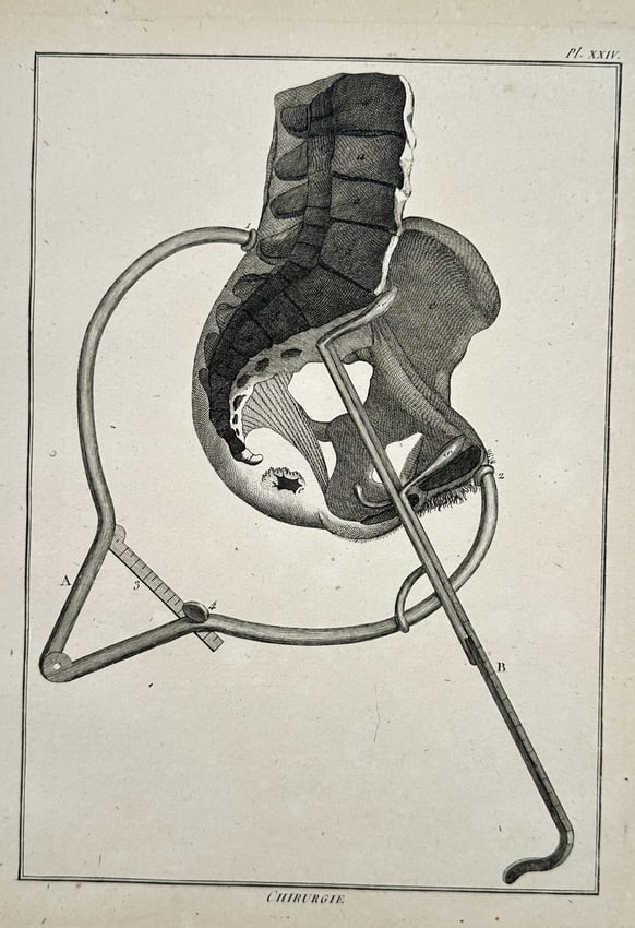 Robert Benard (1734–1777) – Anatomical Study of the Pelvis and Surgical Pelvimeter – Engraving: "Chirurgie" illustrates a detailed anatomical study of the human pelvis and spine in relation to a surgical instrument. The plate features a lateral view of the sacrum, coccyx, and ilium, with a mecha
