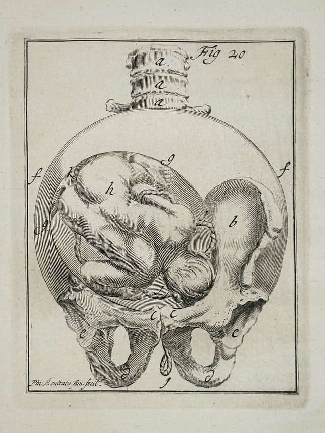 Hendrik van Deventer (1651–1724) – View of a Fetus in the Womb – Engraving (1701): "Fig 20" provides a detailed anatomical study of a fetus positioned within the uterus and pelvic girdle, illustrating the relationship between the maternal skeletal structure and the developing child.