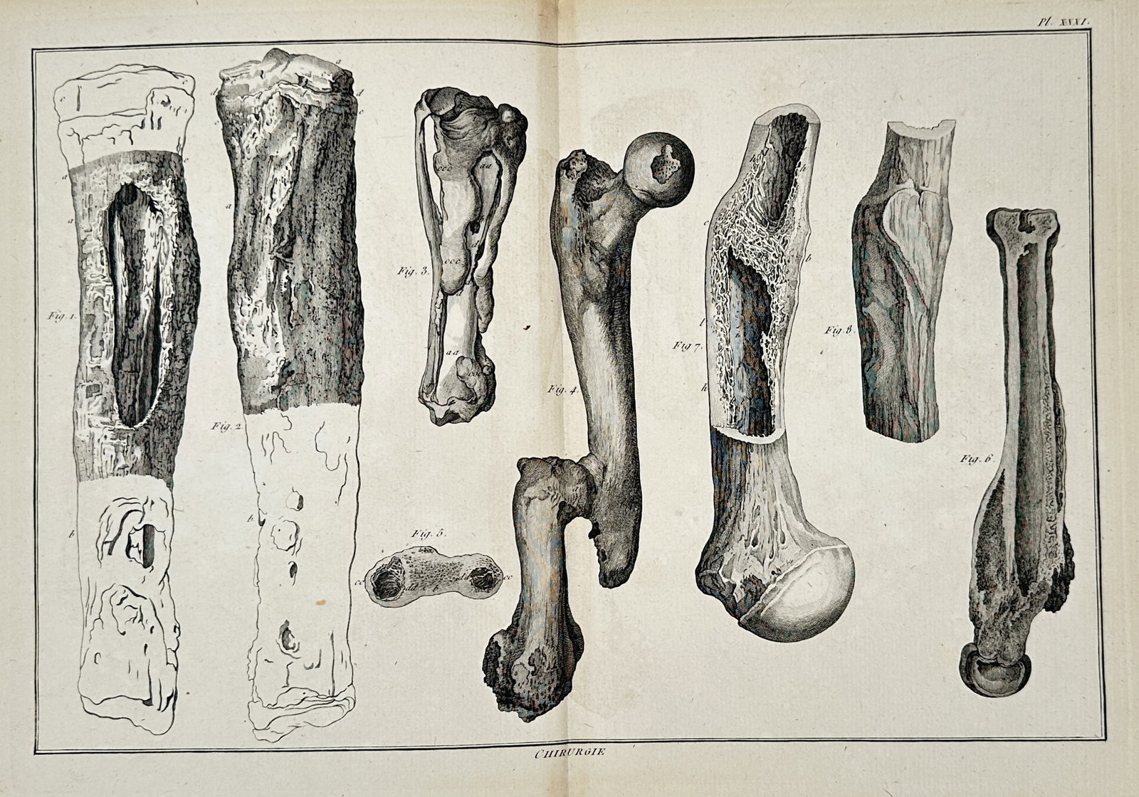 Robert Bénard – View of Surgical Bone Pathology Diagrams – Engraving (c. 1762–1772) (1 of 2)
