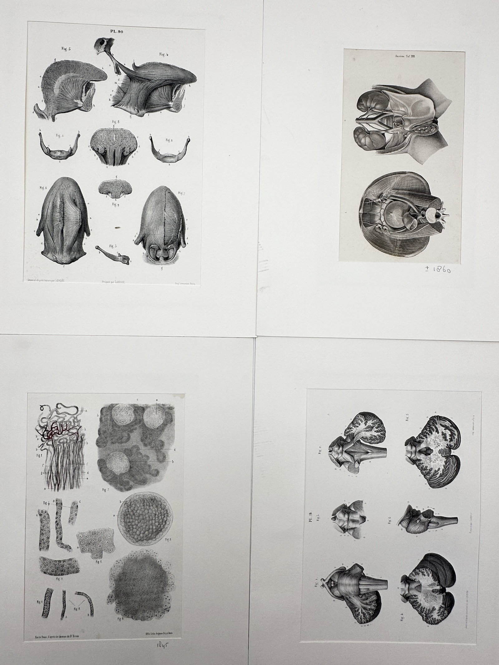 Dr. Carl Ernst Bock – Set of 4: Human Anatomy and Pathological Dissections – Lithograph (1 of 2)