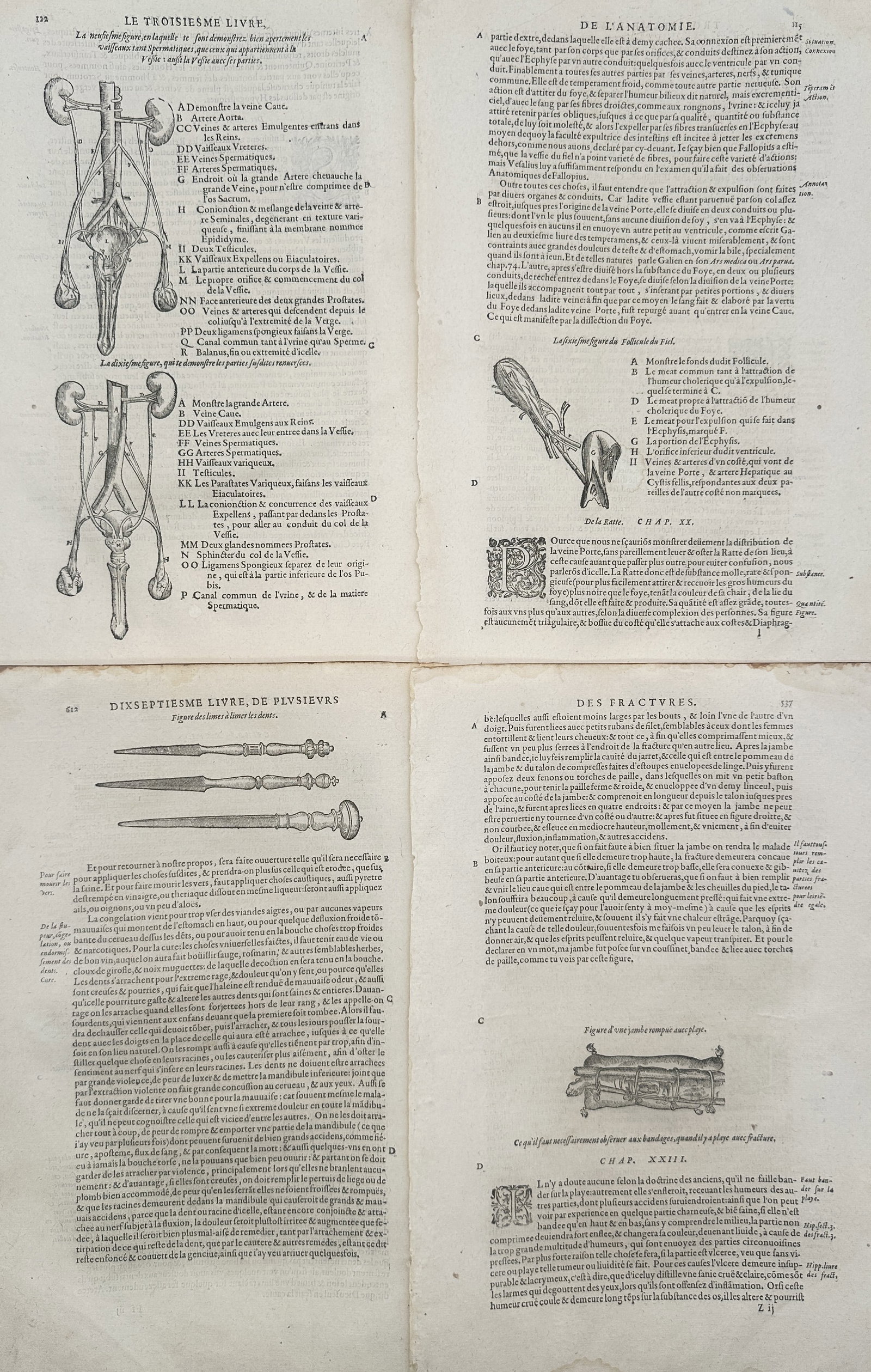 Ambroise Paré – Set of 4: Surgical and Orthopedic Treatise Pages – Woodcuts (16th Century) (1 of 2)