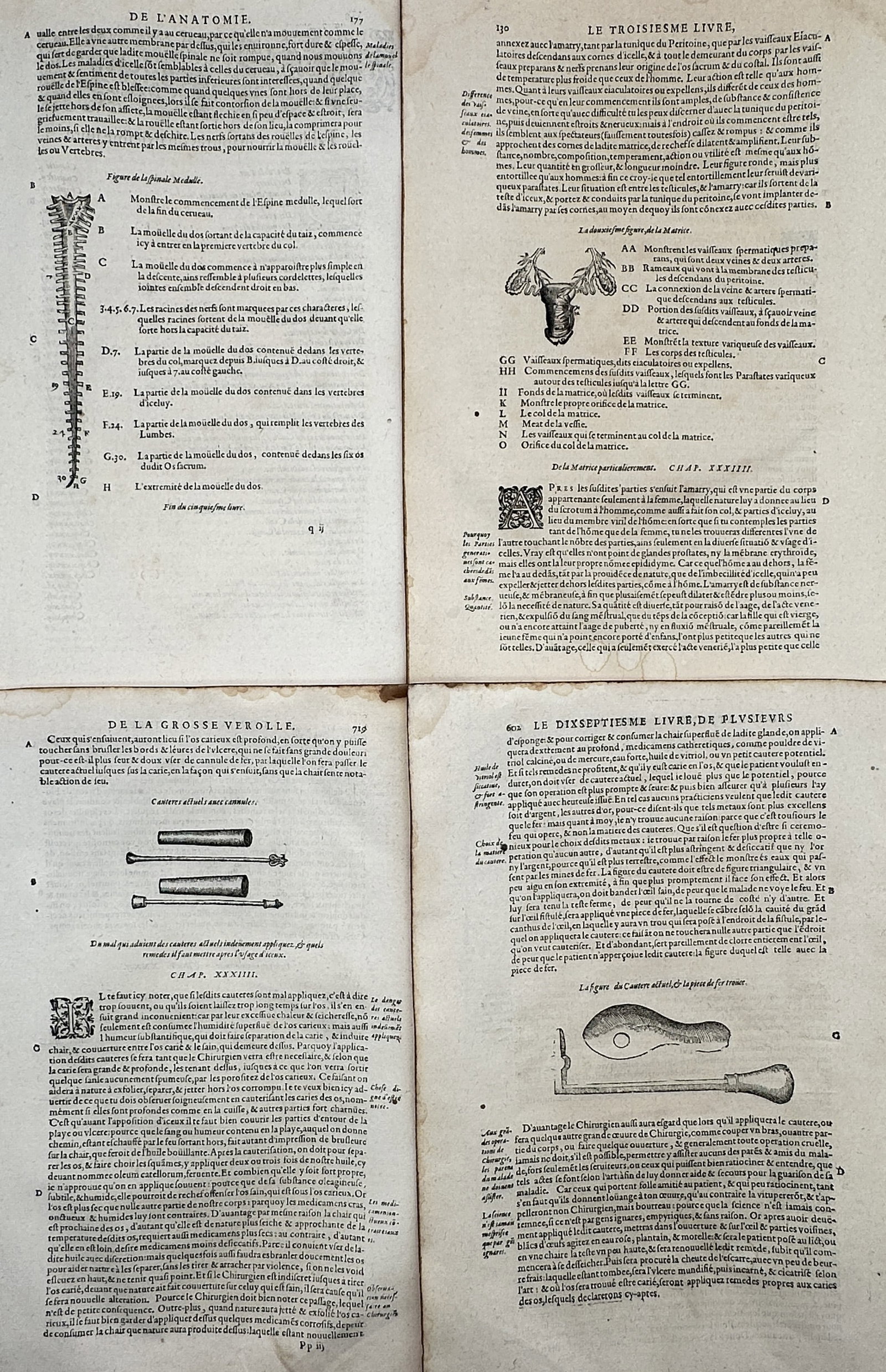 Ambroise Paré – Set of 4: Anatomical and Surgical Studies – Woodcuts (16th Century): "Oeuvres d'Ambroise Paré" This set of four prints displays a general overview of Renaissance medicine and surgery, showcasing detailed woodcuts of the spinal column, uterine anatomy, and various surg