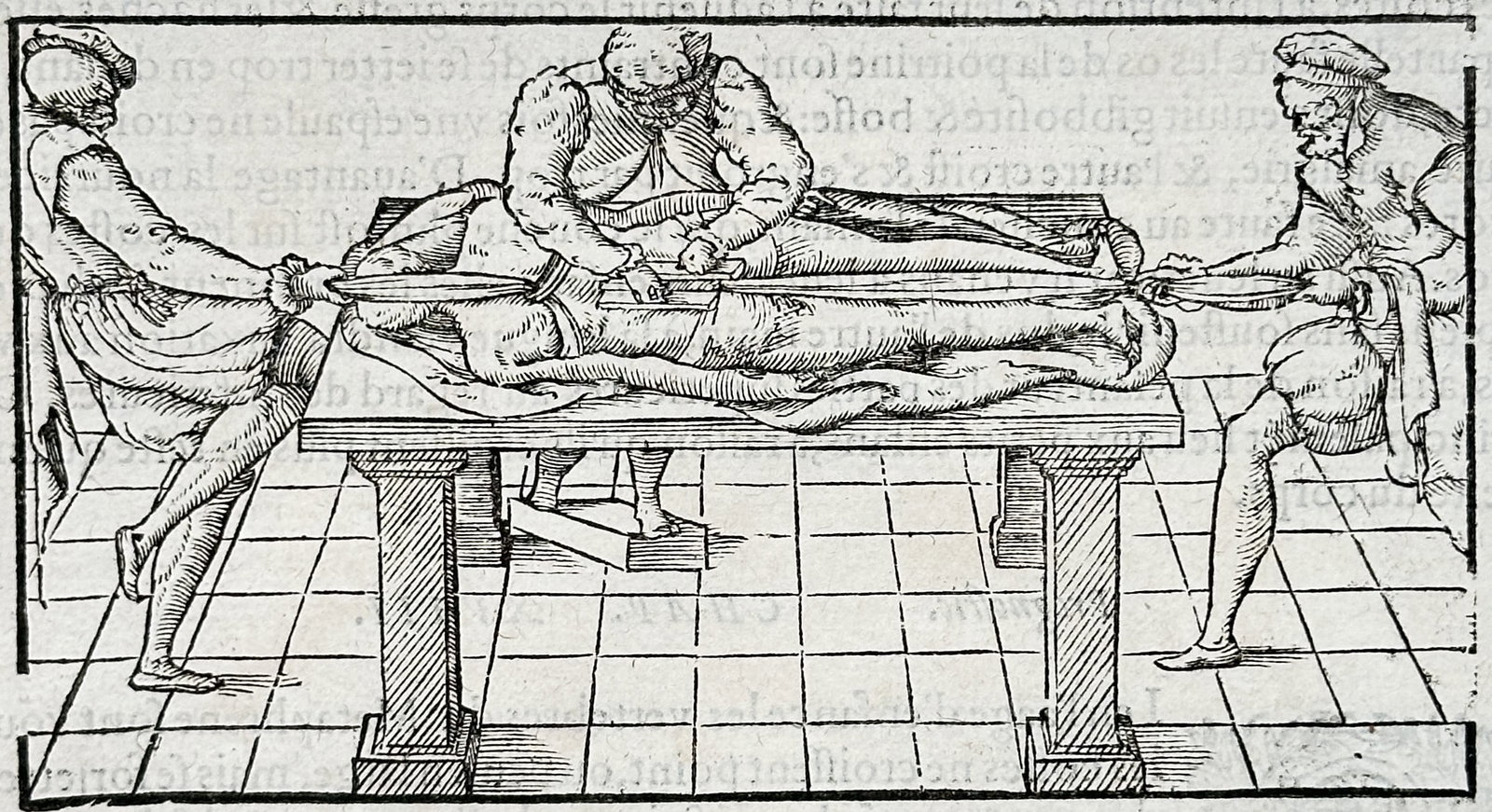 Jacques Daléchamps – Reduction of Vertebral Dislocations – Woodcut (16th Century) (1 of 3)