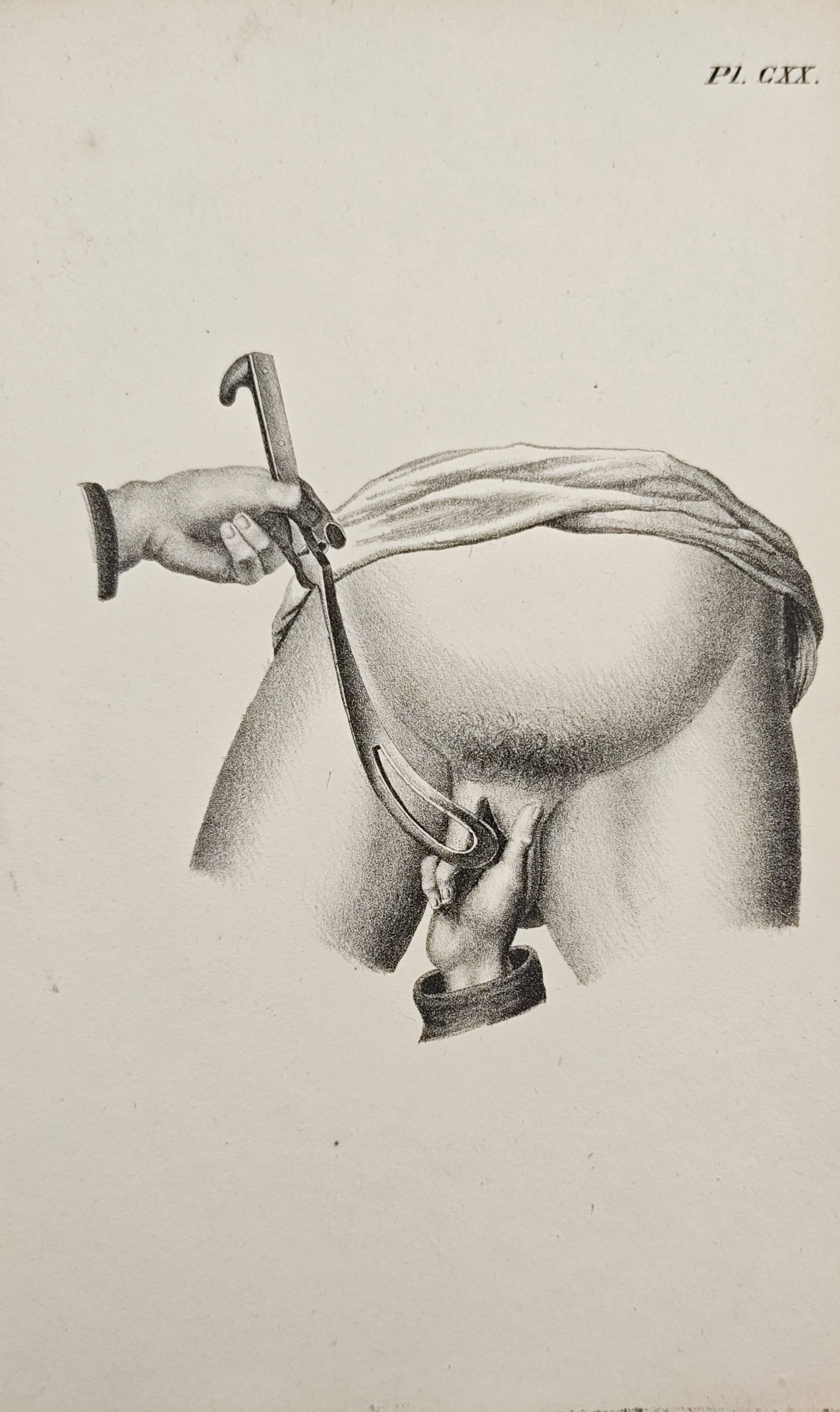 Antoine Chazal – Obstetrical Forceps Application Study – Engraving (19th Century): "Obstetrical Forceps Application Study" presents a technical medical illustration demonstrating the procedural application of curved obstetrical forceps. Rendered as a fine line engraving, the plate s