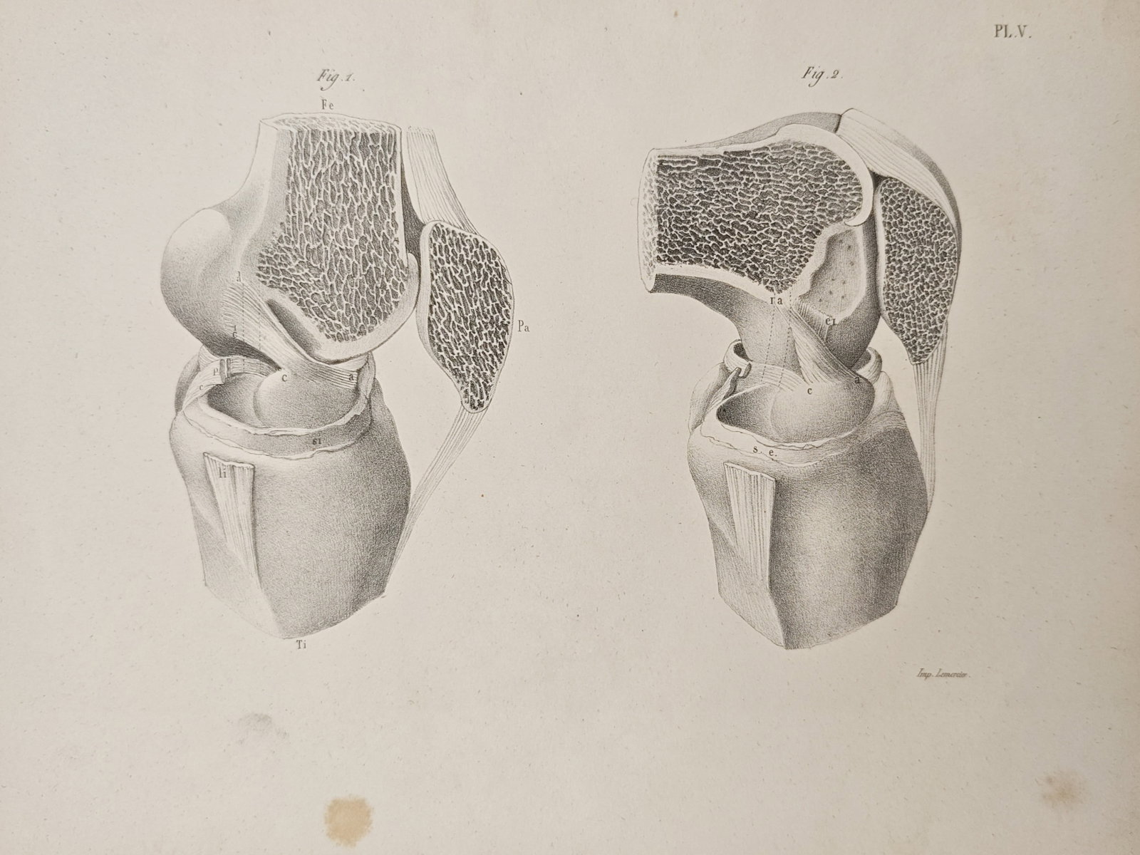 Charles Frederic Martins - Knee Joint Osteology and Articular Anatomy - Lithograph (19th Century): "Anatomical Preparations of the Knee Joint" presents an osteological medical study illustrating cross-sectional and articular views of the knee joint detailing trabecular bone structure, cartilaginous
