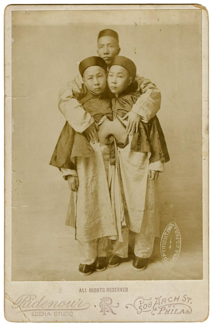 Cabinet Photo of Korean Siamese Twins. Philadelphia: (1 of 1)