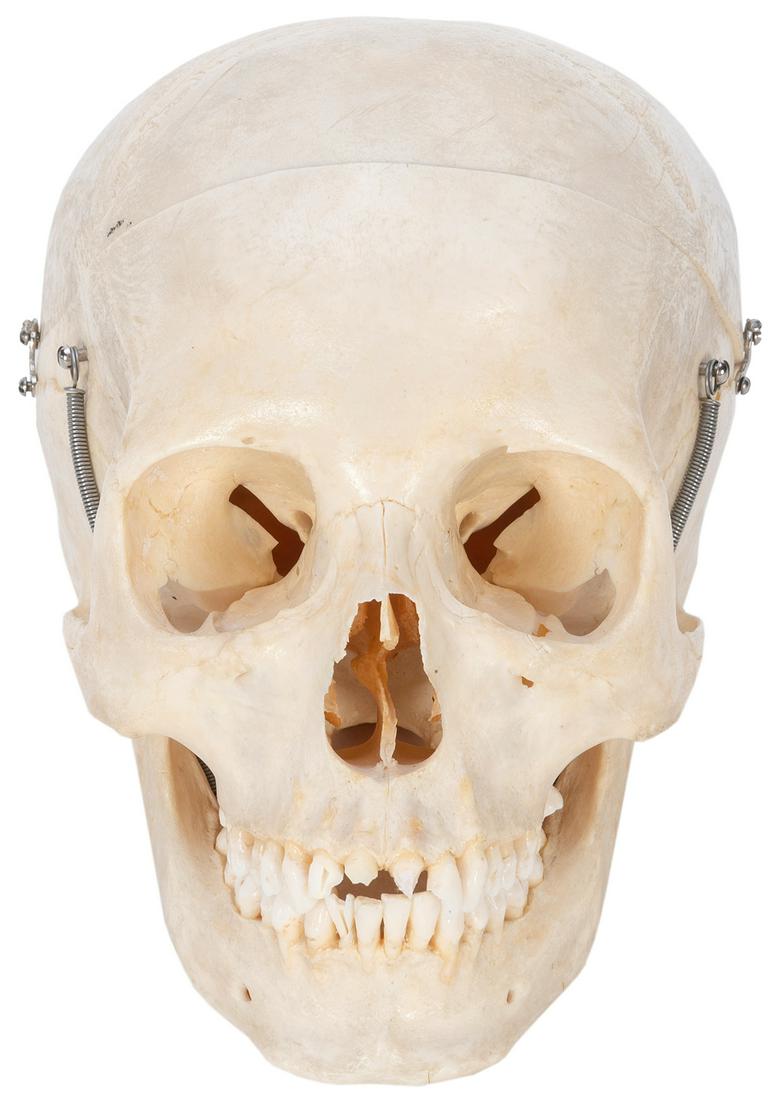 Articulated Human Skull for Medical Study. Prepared by Clay...: Articulated Human Skull for Medical Study. Prepared by Clay-Adams, Inc. (New York), stamped. With wired jaw movement and clasps securing the removable cap. 32 teeth (some broken). Approx. 5 ½ x 5