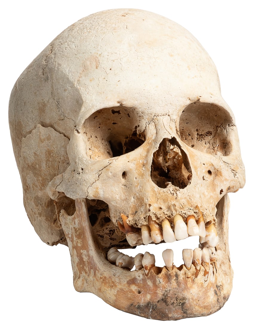 Human Skull. Mandible is loose from skull but is present. 2...: Human Skull. Mandible is loose from skull but is present. 23 teeth are still in the maxilla and mandible (some may be partially loose); 4 teeth are loose. Approximately 8 x 5 x 6¾”. Some we
