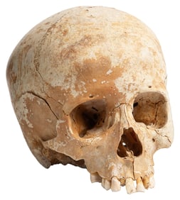 Human Skull. Mandible is loose and broken into two pieces. ...