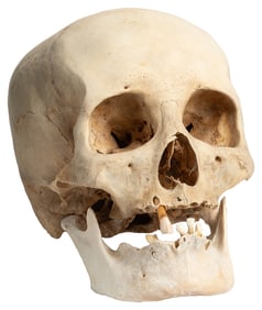 Human Skull. Mandible is loose yet present (possibly suppli...