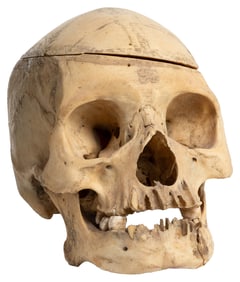 Human Skull. Mandible and top of skull are loose yet presen...
