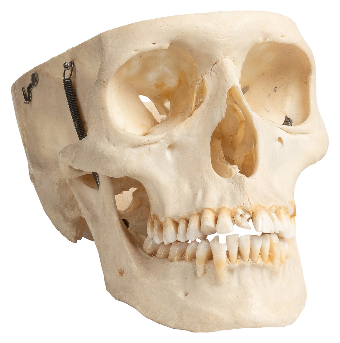 Human Skull. Articulated human skull for medical purposes, ...: Human Skull. Articulated human skull for medical purposes, with spring-held mandible and fasteners to secure frontal bone (frontal bone neatly cut off; frontal bone is missing). 32 teeth are still in