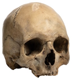 Human Skull. Mandible is missing, 3 teeth are still present...