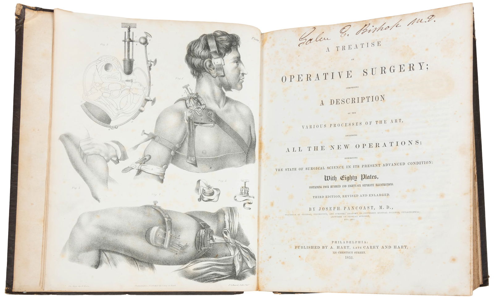 [MEDICINE]. PANCOAST, Dr. Joseph. A Treatise on Operative S...: [MEDICINE]. PANCOAST, Dr. Joseph. A Treatise on Operative Surgery… Philadelphia: A. Hart, 1852. Large 4to. Illustrated throughout with 80 engraved plates. 389 pp. Publisher’s full brown cl