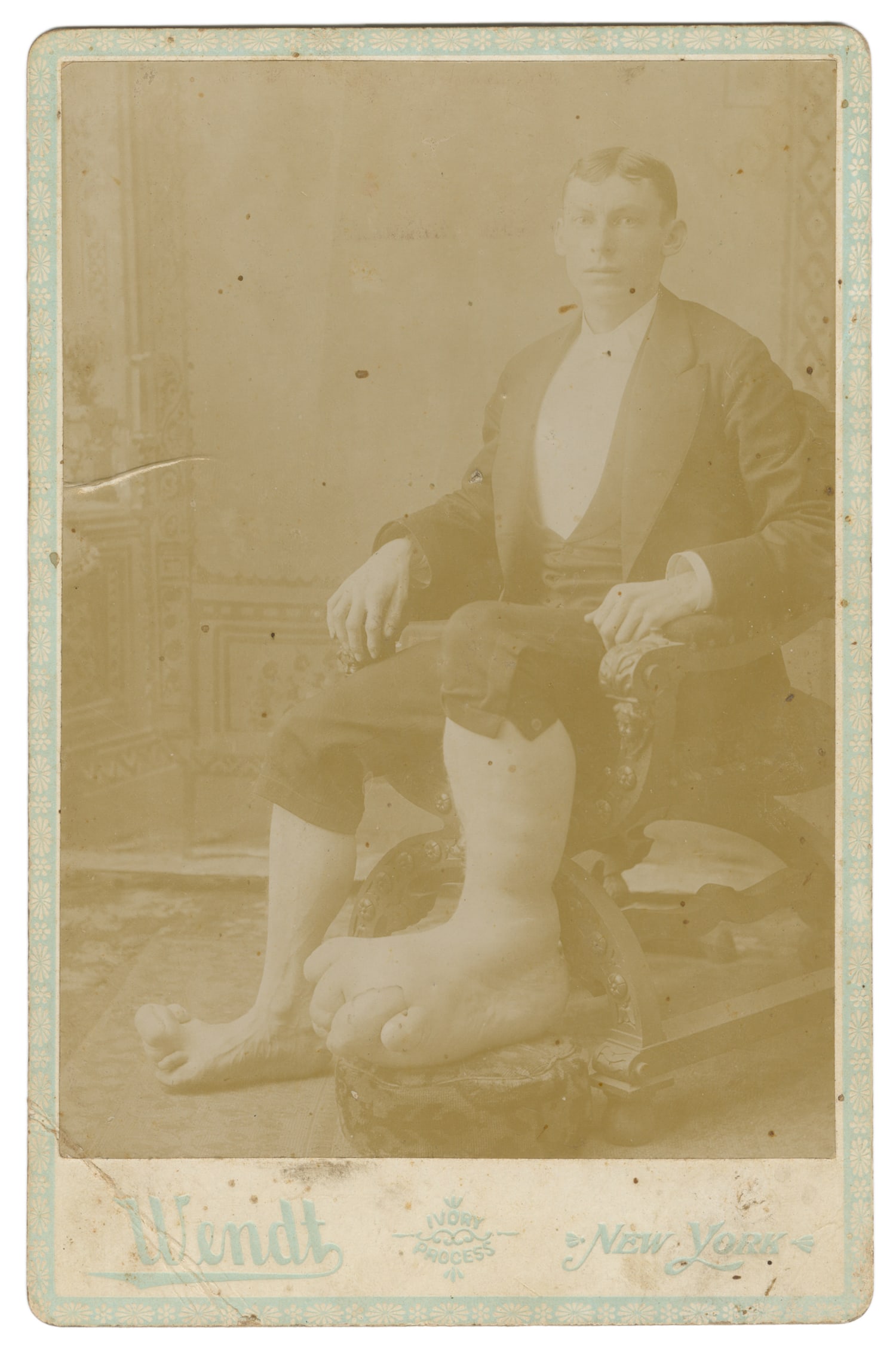 BERRY, Eugene (ca. 1872-?). "Ohio Big Foot Boy" Cabinet Photo.: BERRY, Eugene (ca. 1872-?). "Ohio Big Foot Boy" Cabinet Photo. New York: Wendt, ca. 1890s. Cabinet card photograph of Berry, who lived with either Milroy's disease or Elephantiasis, causing him to hav