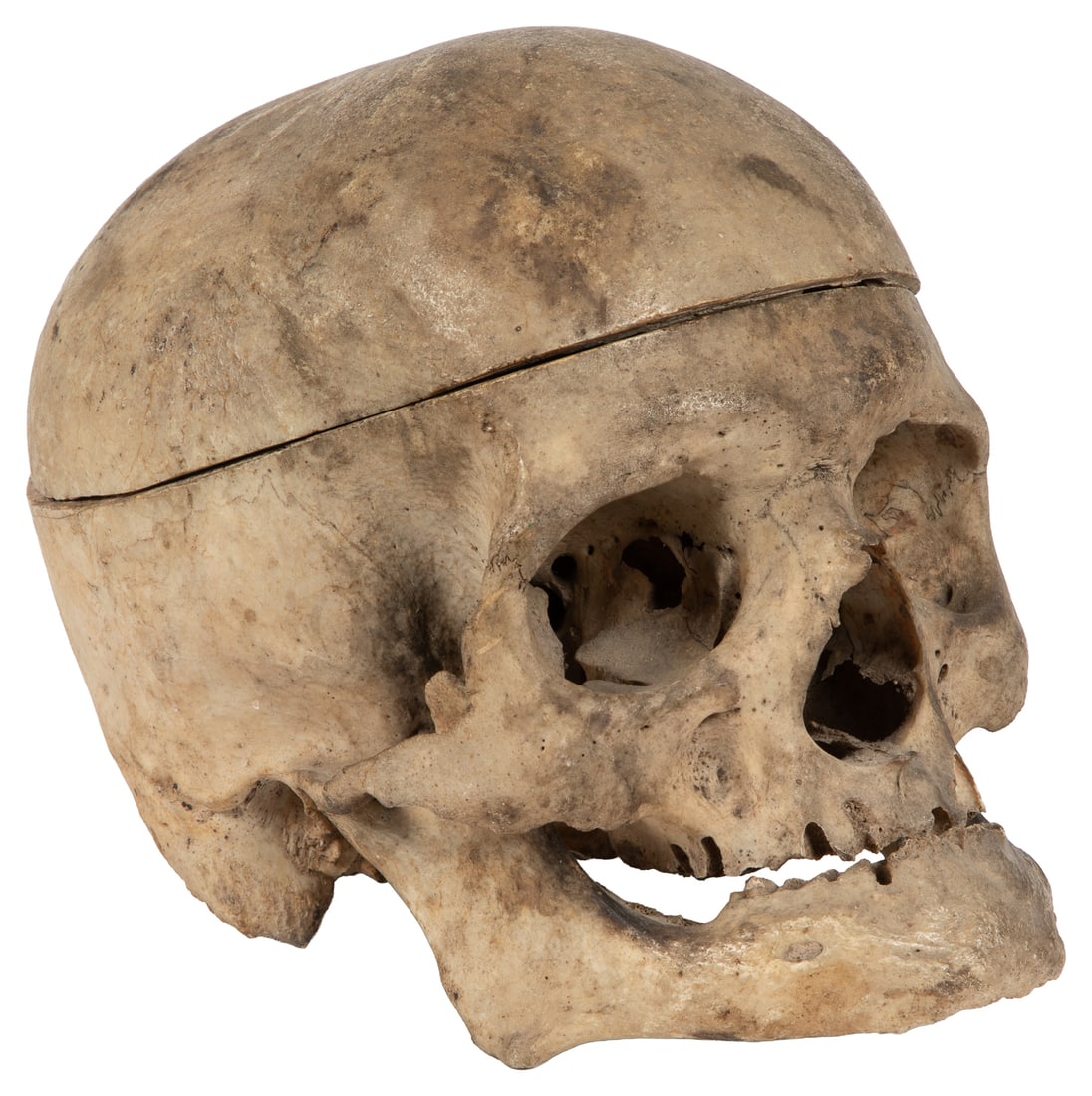 Human Skull With Removable Skull Cap and Mandible.: Human Skull With Removable Skull Cap and Mandible. Medical human specimen with removable skull cap for viewing into the cranium. Mandible detached. Approx. 7 x 8 1/2 x 6".