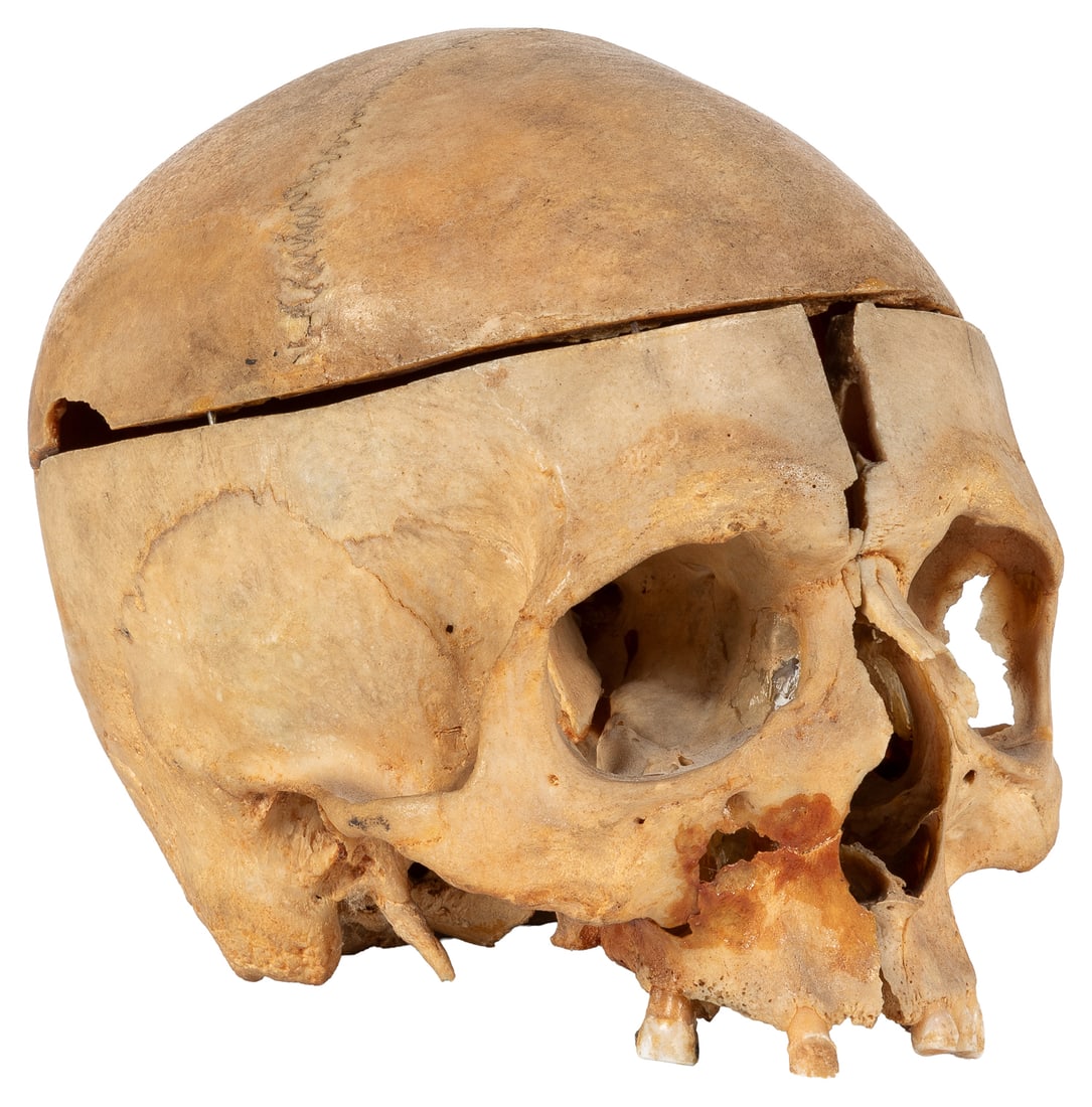 Sagittal Cut Model Skull with Cap.: [ANATOMICAL MODEL]. Sagittal Cut Model Skull with Cap. Two dissected halves of a skull for anatomical study. Includes maxilla with six teeth and the skull cap (with metal pins for attachment and