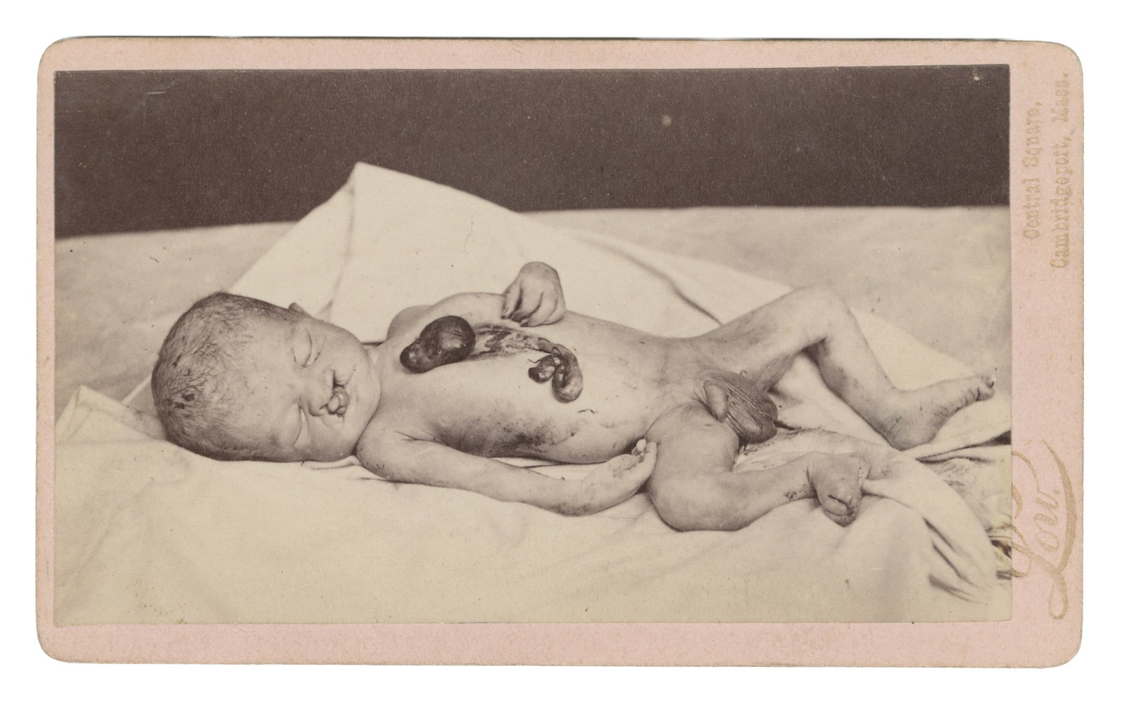 CDV of Infant with Congenital Malformations. Cambridge, MA: Low, ca. early 20th century.: CDV of Infant with Congenital Malformations. Cambridge, MA: Low, ca. early 20th century. Depicts infant with craniofacial (cleft lip and palate) and thoracoabdominal (ectopia cordis) issues. 4 1/4 x