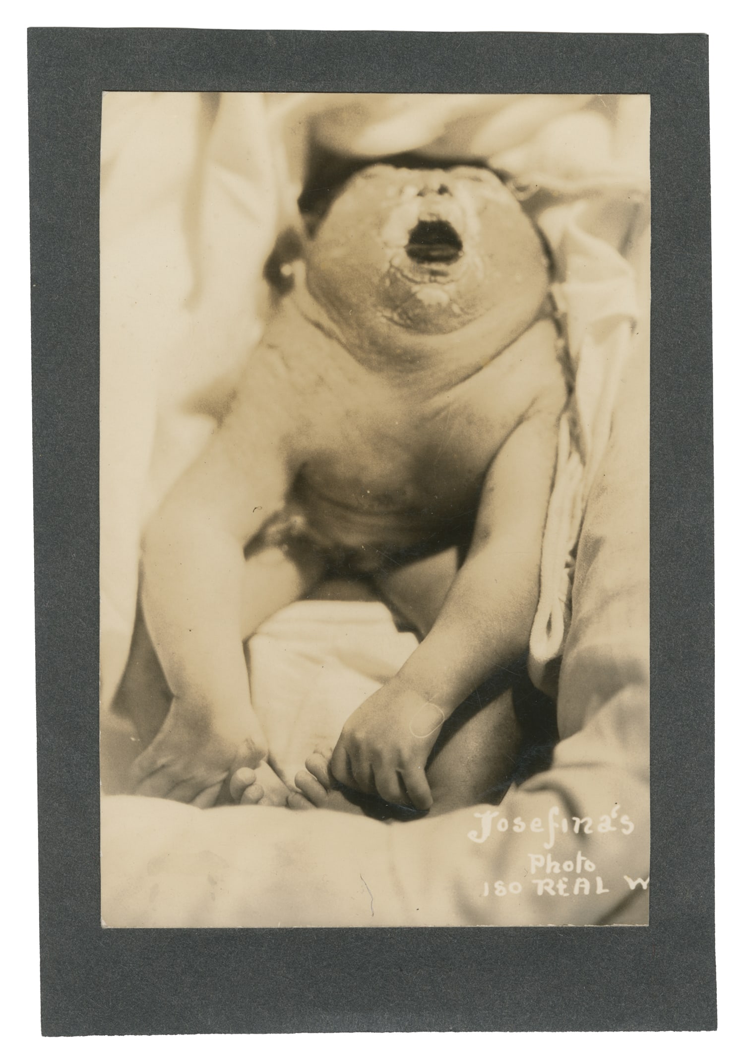 Mounted Photograph of Baby with Anencephaly. Circa 1900.: Mounted Photograph of Baby with Anencephaly. Circa 1900. Anencephaly is a severe birth defect where a baby is born missing major parts of the brain, skull, and scalp. 5 1/4 x 3 1/2".
