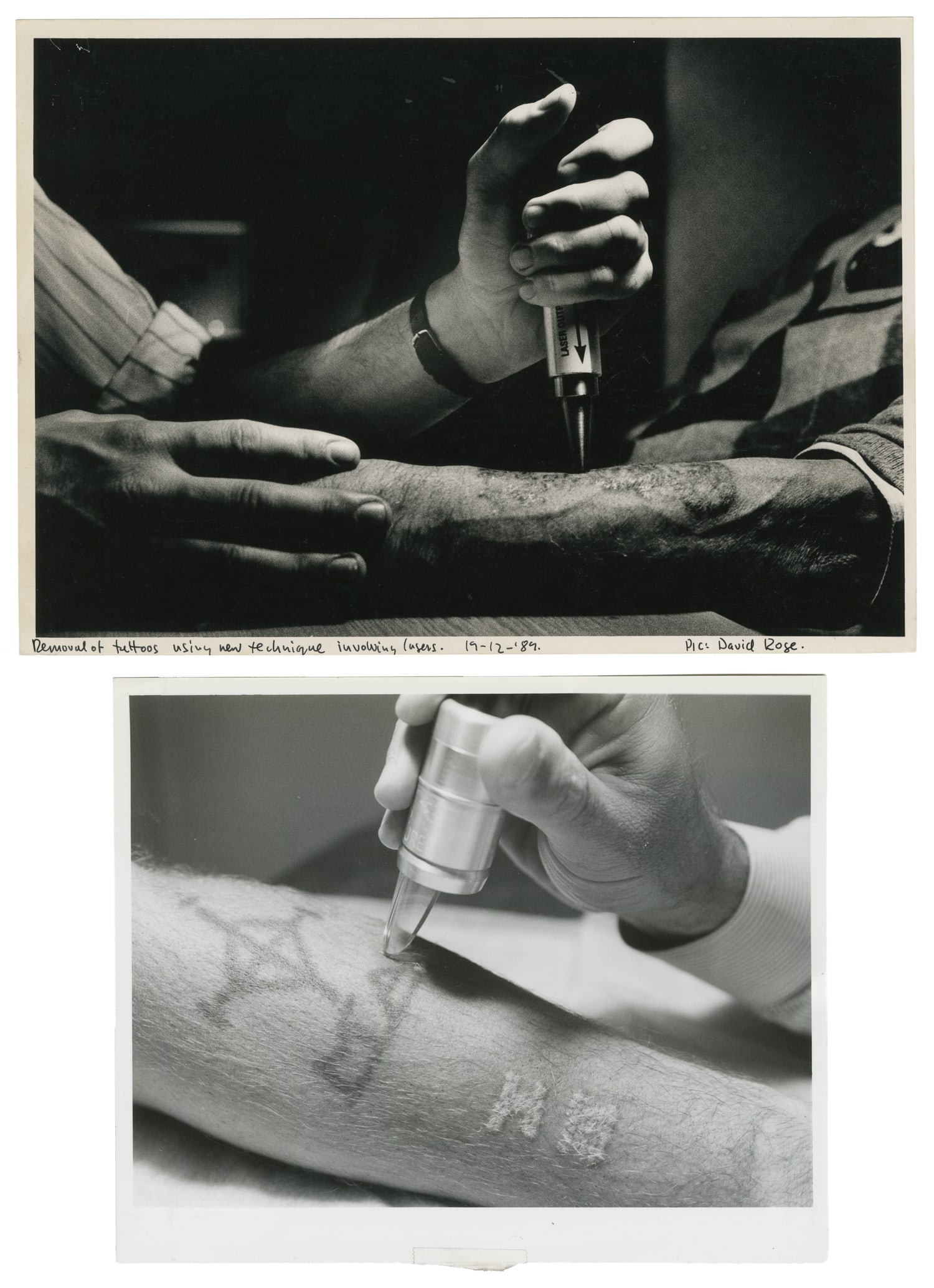[TATTOO]. Four Press Photographs Featuring Early Laser Tattoo Removal. V.p., late 20th Century.: [TATTOO]. Four Press Photographs Featuring Early Laser Tattoo Removal. V.p., late 20th century. Four black and white photos from the 1970s, 1980s, and 1990s featuring the removal of tattoos with the u