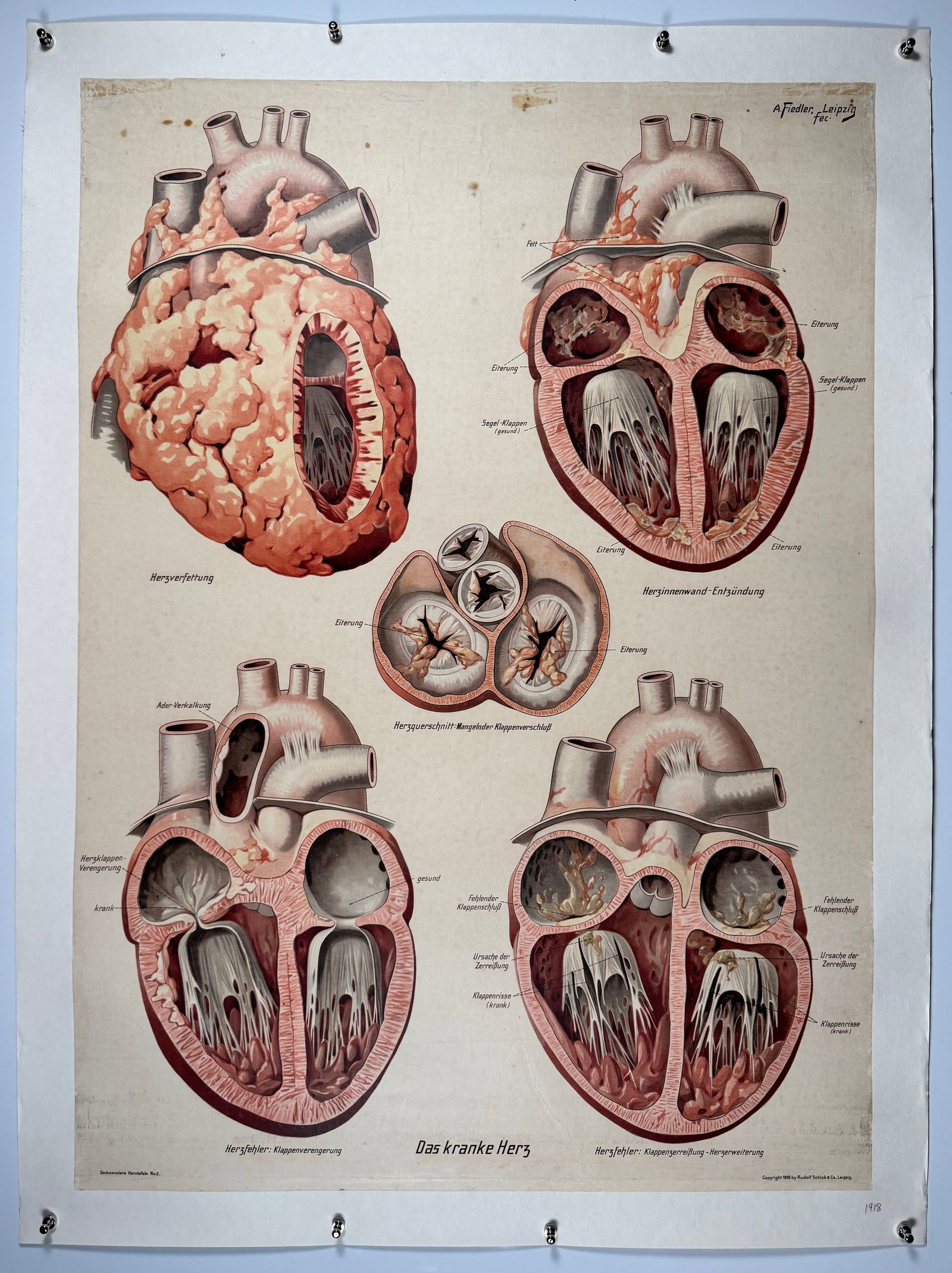 1918 Vintage German Medical Anatomy Poster Das kranke Herz Linenbacked Chart 33x44" (1 of 7)