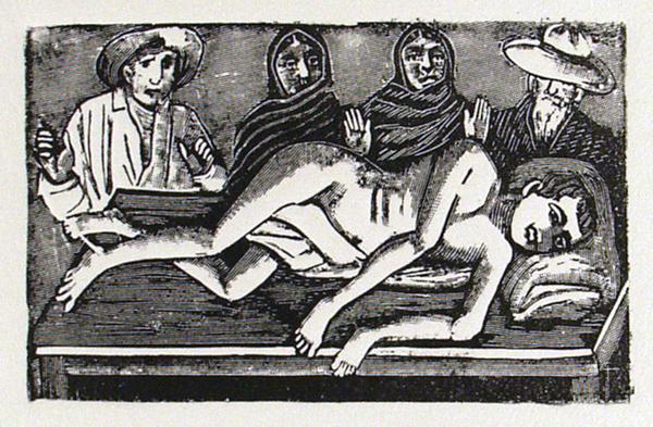JOSE GUADALUPE POSADA (Mexican) Etching: Jose Guadalupe Posada (Mexican, 1851 - 1913). "Untitled [Legs for Arms]". Etching. c1900?. Full margins. 3 1/16 x 4 13/16 in. (78 x 122 mm). Sheet Size: 7 5/8 x 11 in. (194 x 279 mm). Restrike impress