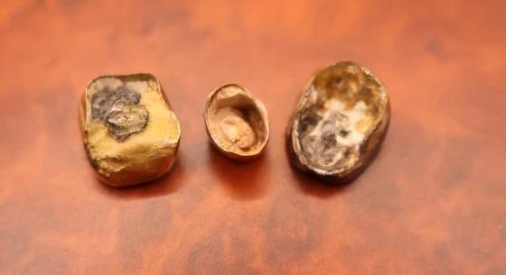 Two Gold Teeth and Dental Mold Tooth - 3